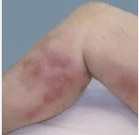 Barizeen diagnostikoa eta konplikazioak