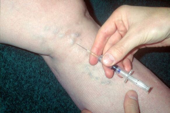 barizeetarako eskleroterapia