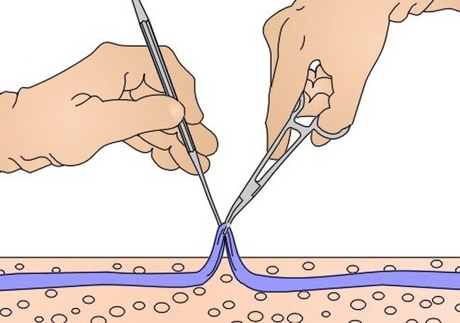 barizeetarako zainak kentzea