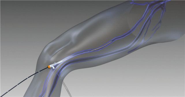 irrati-frekuentzia ezabatzea barizeetarako