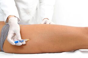 eskleroterapia barizeak tratatzeko metodo gisa