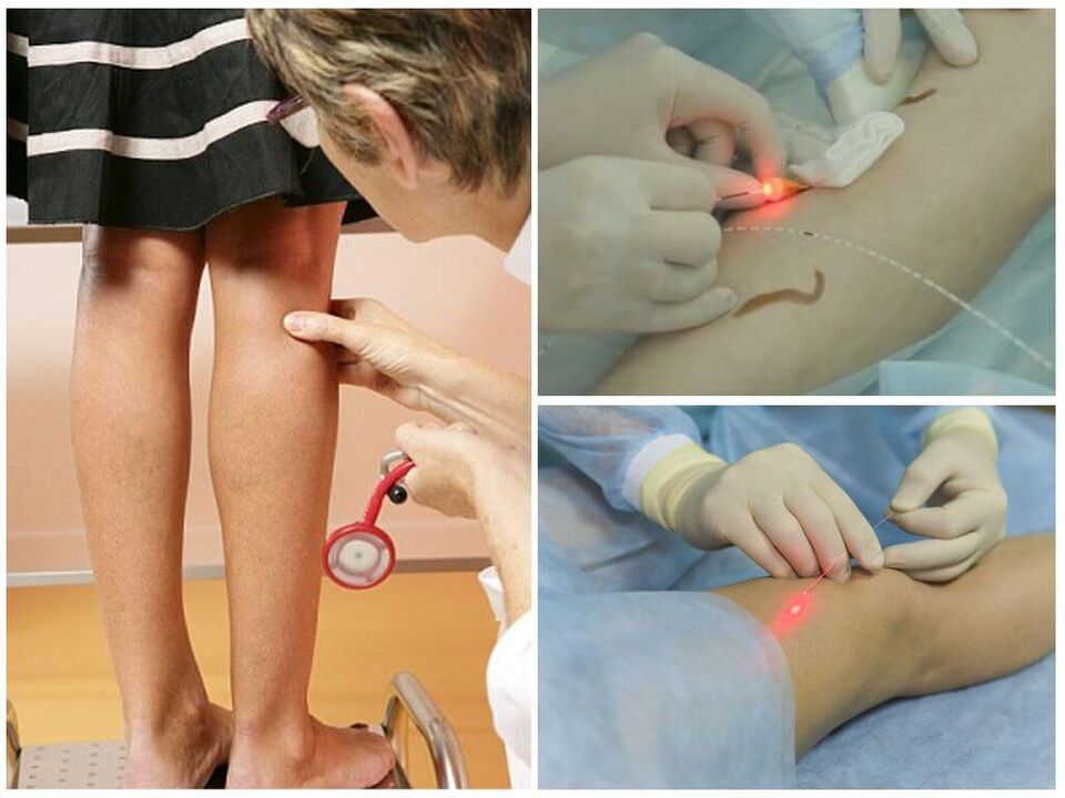 Hanketako barizeak laser koagulazio prozeduraren aurrerapena